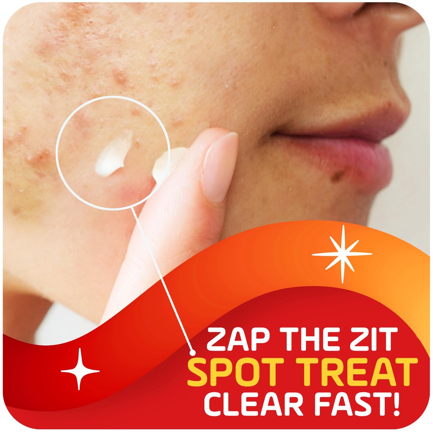 Asepxia 2% Salicylic Acid Acne Spot Treatment Cream | Drying Formula Targets Acne, Clears & Prevents Blemishes, Reduces Redness, Penetrates Pores, Pimple Cream, 1 Oz, 1-Pack, EXP 12/23
